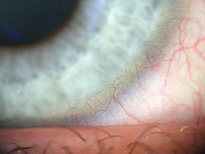 Auge mit Vascularisationen
