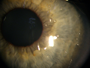 verschmutzte Kontaktlinse auf Auge
